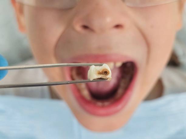 Best Urgent Care for Lost Fillings or Crowns in Stroud, OK
